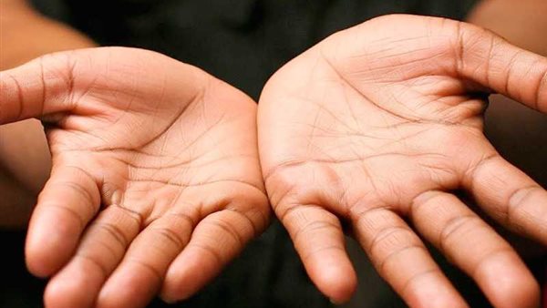 5 علامات باليد  تحذر من حالات صحية خطيرة