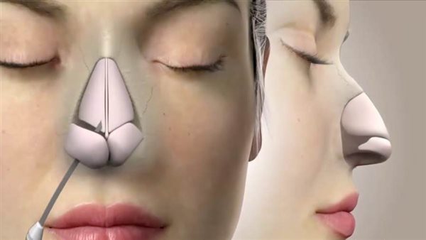هل عملية تجميل الأنف مؤلمة