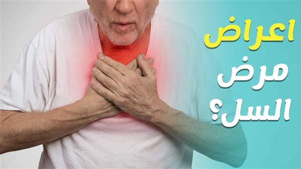 أعراض مرض السل