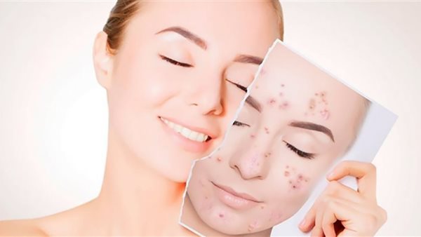 حب الشباب.. ما هى أسباب ظهوره بين السيدات والفنيان وعلاجه