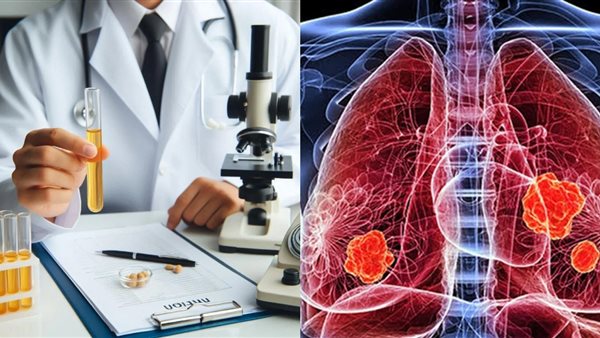 دراسة بريطانية: استخدام البول للكشف المبكر عن سرطان الرئة