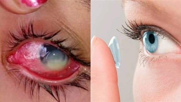 أضرار ارتداء العدسات اللاصقة أثناء النوم