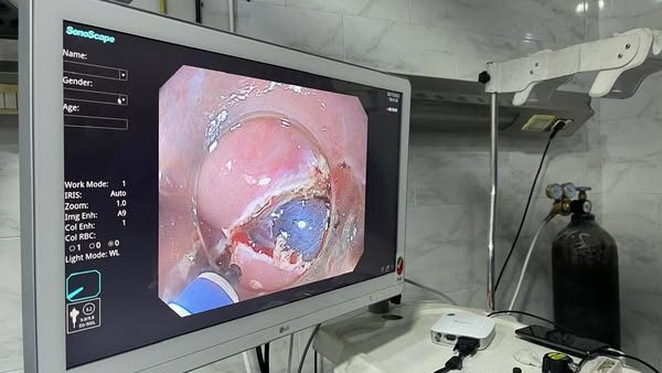 الفراغ الثالث.. نجاح جديد في تقنيات المناظير الجراحية