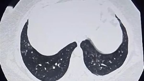 صورة من إشاعة للمريضة