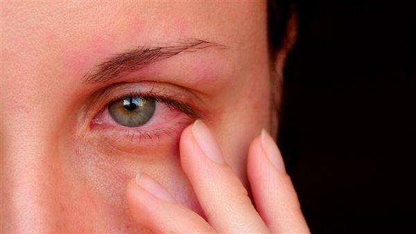 علاج حساسية العين في الربيع