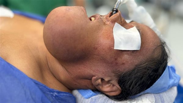 نجاح جراحة دقيقة لإزالة ورم نادر من فك مريضة بمستشفى الشيخ 