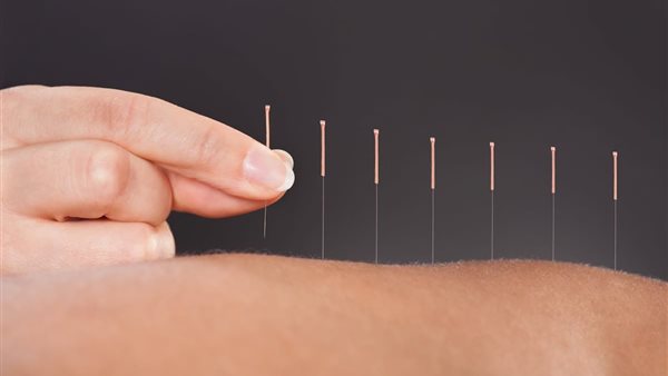 مراكز الإبر الصينية