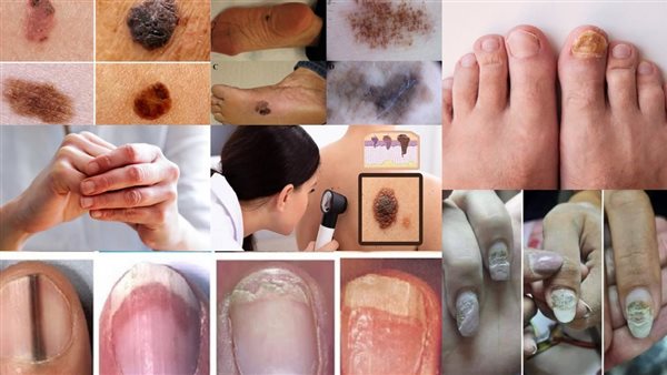 5 علامات صامتة تحذرك قبل الإصابة بـ السرطان