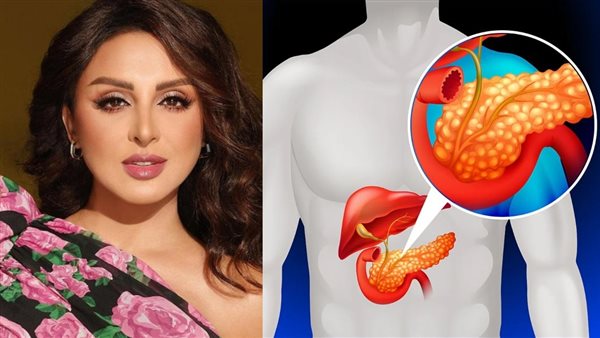 شائعة إصابة الفنانة أنغام بسرطان البنكرياس