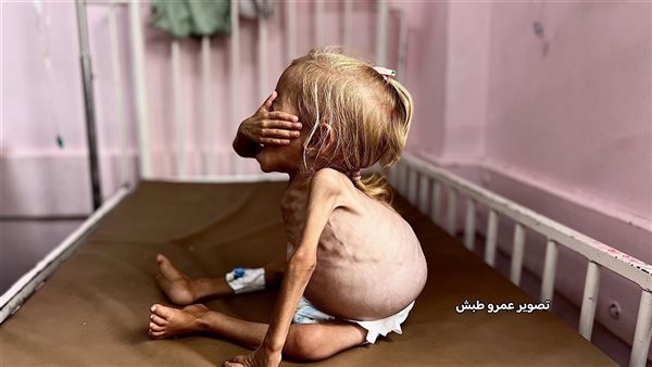 التجويع سلاح إسرائيل في حريها ضد غزة لإبادة الشعب بالكامل (خ