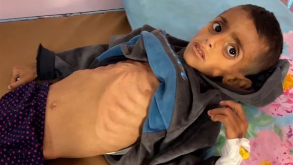 غزة تحارب مرض شلل نادر حاد في ظل حصار الاحتلال الإسرائيلي