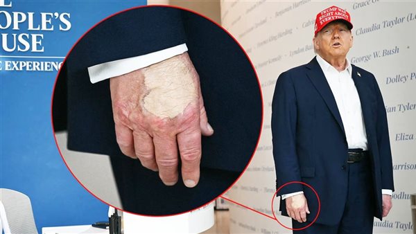 سر وضع ترامب مساحيق التجميل على يده اليمنى