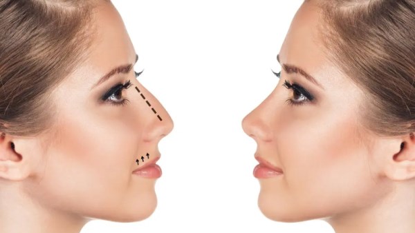 تجميل الأنف