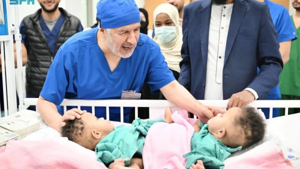 فصل التوأم الملتصق