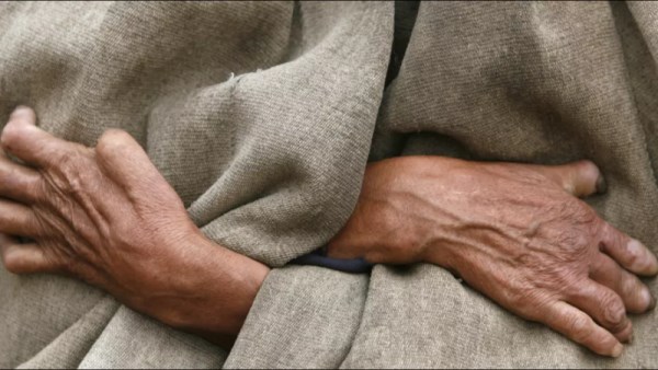 مرض الجذام 