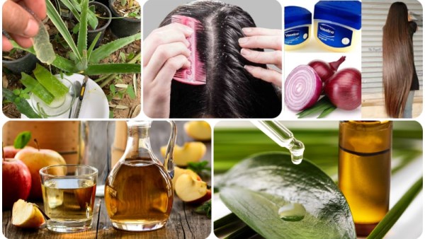 6 طرق طبيعية تخلصك من قشرة الشعر نهائيًا 