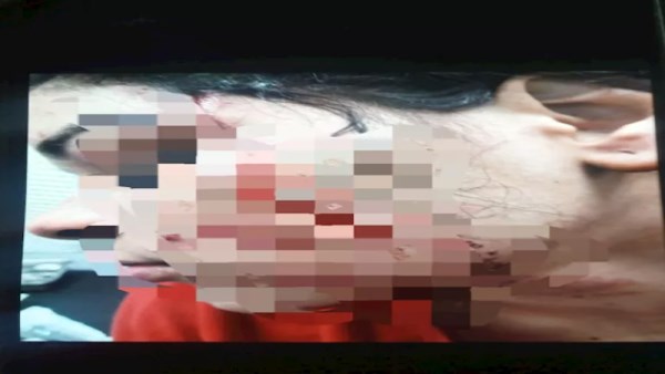 شيماء بعد الإعتداء عليها من قبل اختها ماجدة 