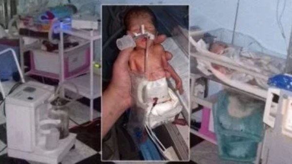 مأساة في حضانة خاصة بالقاهرة.. إهمال طبي يتسبب في فقدان بصر توأم خدج