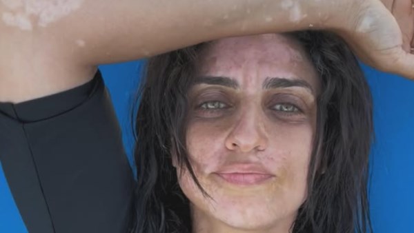 تعرض نسرين كرارة لمرض البهاق