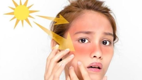 حروق الشمس المتكررة تزيد خطر الإصابة بسرطان الجلد
